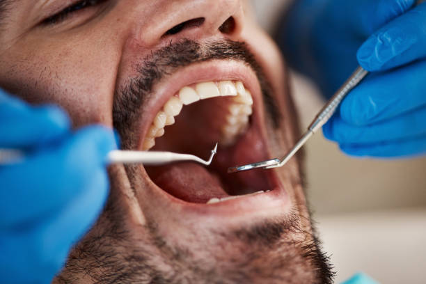 Best Emergency Wisdom Teeth Removal in Riva, MD